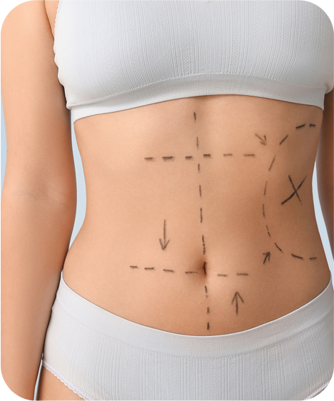 Liposuction Surgery