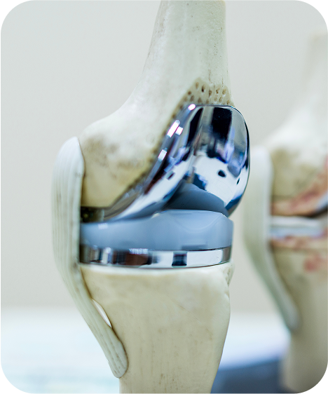Knee Replacement